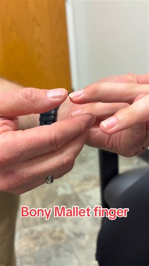 Mike Galbraith on Instagram: "What’s a bony Mallet finger? #medstudent #physician #sportsmedicine #malletfinger #doctor #familymedicine #sportsmed #familymedicineresidency #orthopedic #fingerinjury"