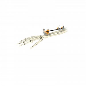 [Hot Item] Hoffman Combination External Distal Radius Fixator Small Fracture