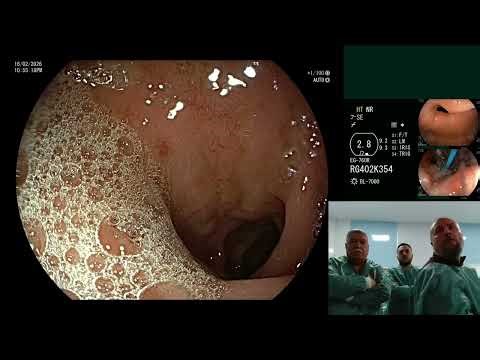 Endoscopic Management of Food Bolus Impaction Post-Nissen Fundoplication