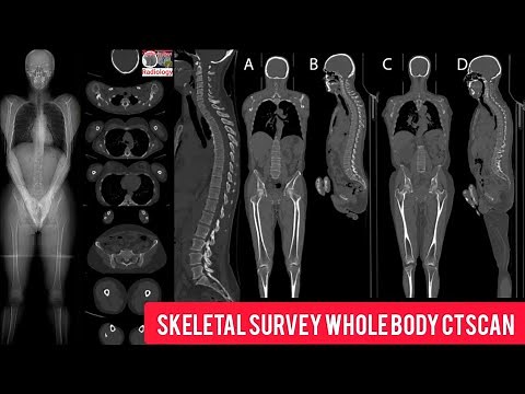 Whole Body Ct Scan | Skeletal Survey CtScan | #wholebody #ctscanwholebody @radiologydept