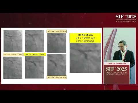 Room A- A1- How Intravascular Imaging guided our case: strategy for a double ostium ISR?