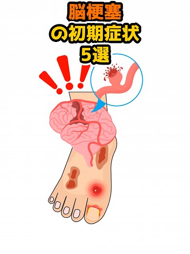 脳梗塞の初期症状を見逃すな！