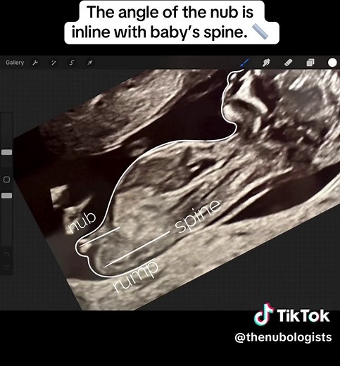 Predict Baby Gender Using Nub Theory Ultrasound Guide
