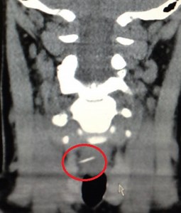 X-rays reveal painful household objects in an unlikely place