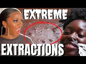 Reacting to EXTREME Blackhead Extractions on Black Skin