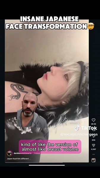 This Japanese facial transformation is going viral and there is a lot to unpack. 👀 The jawline work is undeniable. A stronger jawline, submental liposuction to clean up the chin area, and what looks like filler or fat to sharpen the gonial angle. And here is the thing about a sharp, voluminous gonial angle on a man , it is genuinely one of the most attractive features a face can have. 😱 But the chin. 😬 From the front angle, it reads as way too sharp. Like a dagger on the face. What some are c