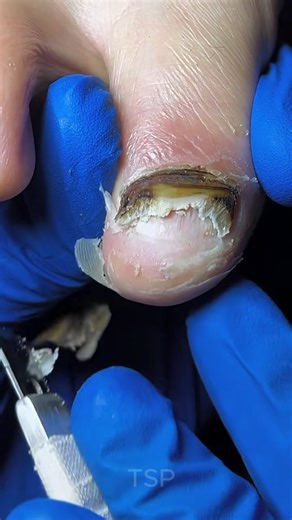 Toenails repaired perfectly 🫧#toenailcleaning | Pictures of Art