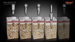64K views · 243 reactions | Coming soon. El mejor sistema cirugia guiada del mundo fue fabricado por OSSTEM-HIOSSEN El más sencillo , El más Rápido y El más Seguro. Informe : +52 1 55 1356 8103 | Graphy Miguel | Facebook