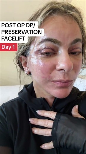 Day post op deep plane facelift preservation style with Dr