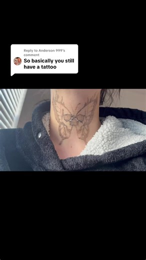 Effective Tattoo Removal: 6 Month Comparison