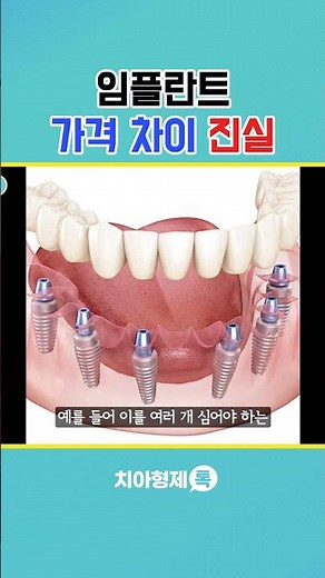 임플란트 하기전에 꼭 알고가야하는 방법 #임플란트가격 #임플란트비용