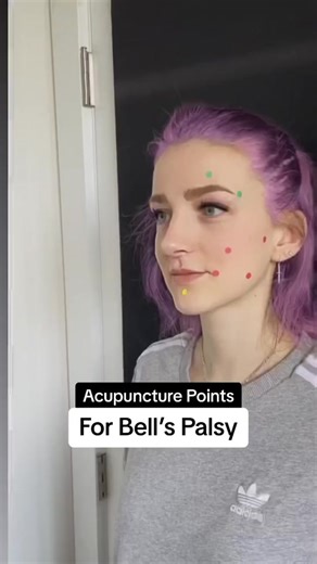 💨Acupuncture rocks when it comes to Bell’s Palsy! Western medicine cannot do much, so acupuncture comes to the rescue! 💨The key point here is to treat Bell’s Palsy as soon as it was diagnosed! The longer the patient waits, the harder it is to get full facial function back. 💨I’ve seen patients recovering within 8 weeks with 2 treatments per week! Not only acupuncture will lessen the pain, it will help restore facial function too! 💨In TCM, Bell’s Palsy is considered Wind and often is associate