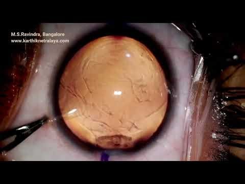 Toric ICL implantation for Myopic astigmatism.