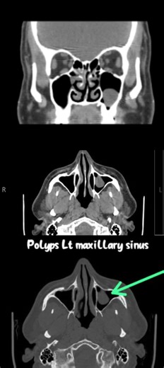 Left maxillary sinus polyp #radiographer #anatomy #biology #radiology #medicaldiagnosis #neet