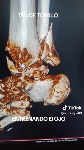 #tobillo #TAC #tomografia #radiologia #radiology #medicina #fyp #xraytech #xray #rayosx #enfermeria #fractura