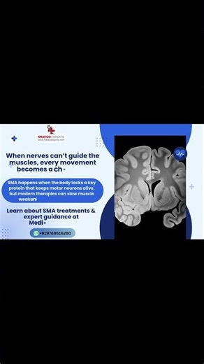 Spinal Muscular Atrophy
