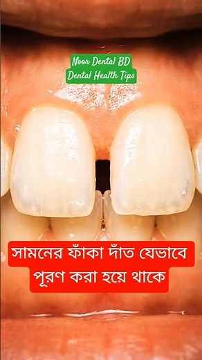 How to fill a gap in a tooth @DentalHealthTips