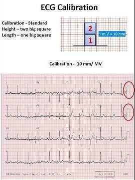 ECG Calibration