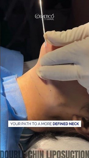 Double Chin Liposuction | Sculpted and Defined Jawline | Dr. Kamal