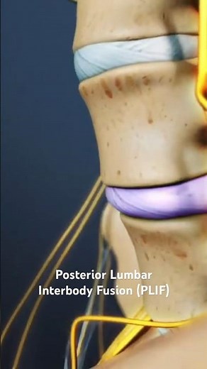 Posterior Lumbar Interbody Fusion (PLIF)