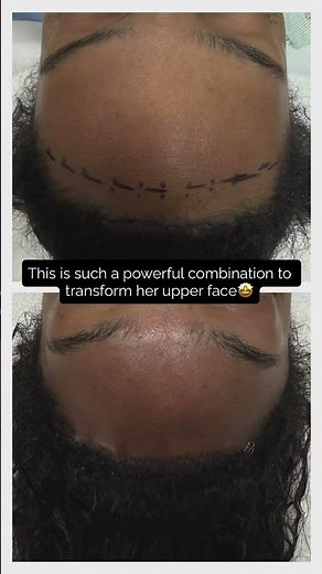 Brow bone reduction and hairline lowering before and after - Dr. Sarah Saxon