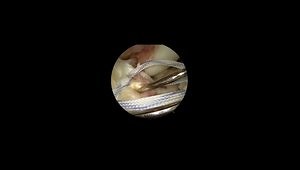 Arthroscopic Fixation of a Tibia Intercondylar Eminence Fracture