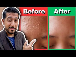 How to Rid Fungal Acne | Fungal Acne Treatment THAT WORKS for Malassezia Folliculitis