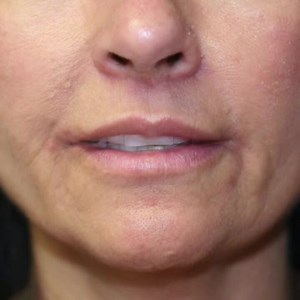 Upper Lip Lift and Corner of Lip Lift