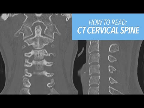 How to Read a CT of the Cervical Spine for Beginners