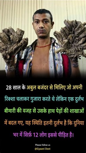 The Real “Tree Man” Disease That Shocked the World 😨#didyouknow #treeman