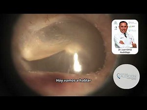 Perforated eardrum. Symptoms and treatment