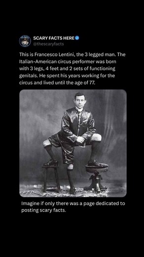Scary on Instagram: "Francesco Lentini, known as "The Three-Legged Man," was born on May 18, 1889, in Sicily, Italy, with a rare congenital condition called polymelia. He had three legs, four feet, and two sets of functioning genitals, but despite his unusual physical appearance, Lentini adapted and lived a relatively normal life. He joined the circus in the United States, becoming a popular performer and attraction with Ringling Brothers and Barnum & Bailey Circus, among others. Lentini learned