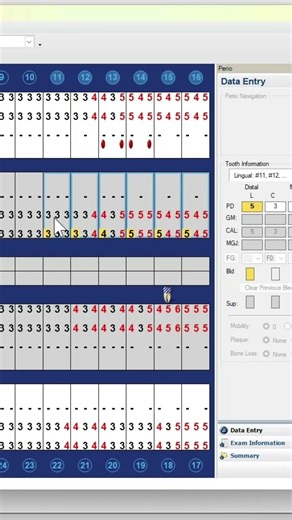 How to add multiple bleeding sites on Dentrix Perio Chart QUICKLY #dentrix #dentalhygienist