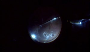 Severe Posterior PVR Following Retinal Detachment Surgery - Eyetube