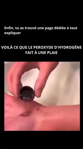 Savoir e science on Instagram: "Lorsqu’on applique du peroxyde d’hydrogène sur une plaie, la zone devient généralement blanche et commence à mousser. Cette réaction se produit car le peroxyde d’hydrogène se décompose en eau et en oxygène lorsqu’il entre en contact avec l’enzyme catalase, présente dans le sang et dans les cellules endommagées. L’aspect blanchâtre est dû à la libération rapide d’oxygène, qui forme des bulles et soulève légèrement la surface de la peau. Bien que cet effet moussant