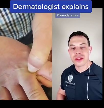 A Dermatologist Explains Pilonodal Sinus