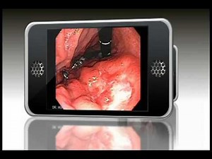 Animación de Endoscopia con Cancer Gastrico