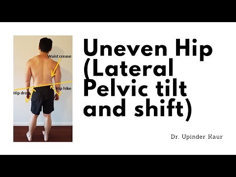 Lateral Pelvic tilt and Pelvic shift