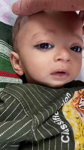 Understanding Pierre Robin Syndrome: Symptoms and Treatment