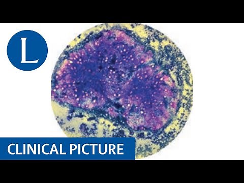 Severe anorexia nervosa and pancytopenia
