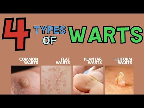 THE 4 MAIN TYPES OF WARTS!