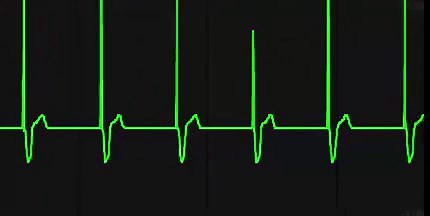 Conduction Disorders/Dysrhythmias (PEARLS)