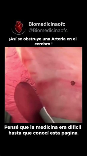 ✨ ¿QUÉ ES UN ICTUS Y POR QUÉ ES UNA EMERGENCIA REAL? 🧬