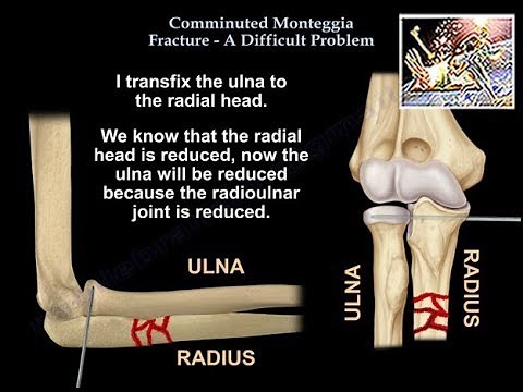 Comminuted Monteggia Fracture Difficult Problem - Everything You Need To Know - Dr. Nabil Ebraheim