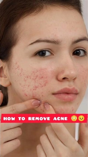 7 Day Challenge 😳😣...|| #acne #pimples #acnescars #skincare #glowup #7daychallenge #shortfeed