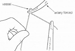 Ligature (medicine) - Alchetron, The Free Social Encyclopedia
