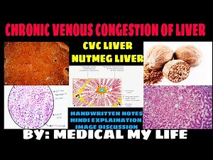 CVC LIVER | NUTMEG LIVER | Hemodynamic Disorder I Pathology