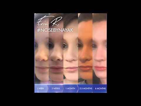 Healing After Rhinoplasty: The Real Story