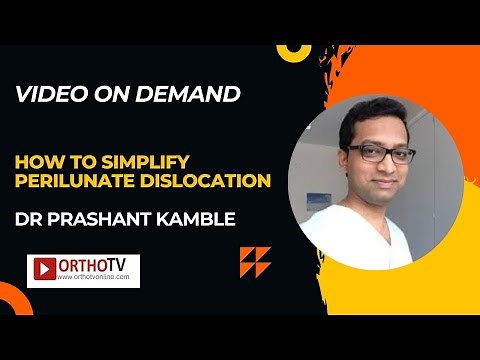 How to Simplify Perilunate dislocation - Dr Prashant Kamble