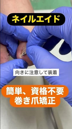 簡単！痛くない！巻き爪矯正！「ネイルエイド」繰り返し使える